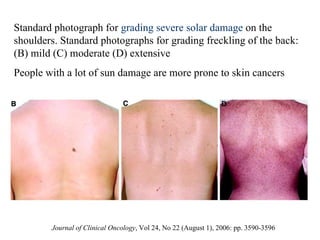 Standard photograph for  grading severe solar damage  on the shoulders. Standard photographs for grading freckling of the back: (B) mild (C) moderate (D) extensive People with a lot of sun damage are more prone to skin cancers Journal of Clinical Oncology , Vol 24, No 22 (August 1), 2006: pp. 3590-3596  