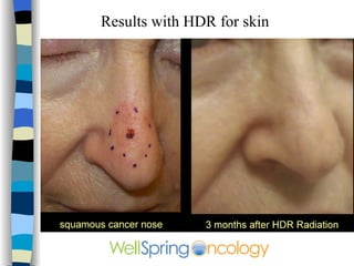 Variety of Melanoma Skin Lesions 