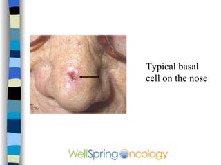 Typical basal cell on the nose 