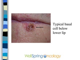 Typical basal cell below lower lip 