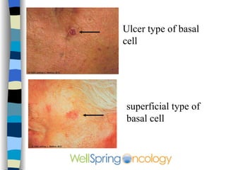 Ulcer type of basal cell superficial type of basal cell 