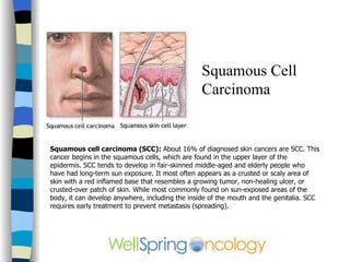 Classic presentation of basal cell 