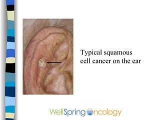 Classic superficial basal cell 