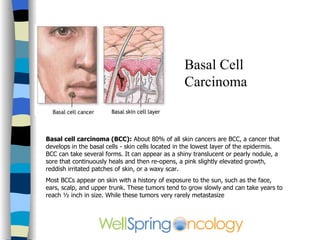 Basal Cell Carcinoma Basal cell carcinoma (BCC):  About 80% of all skin cancers are BCC, a cancer that develops in the bas...