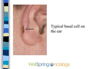 Typical basal cell on the ear 