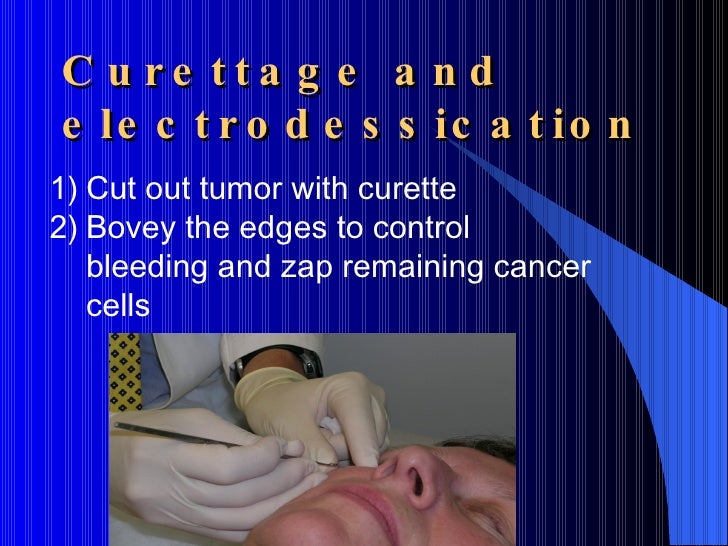 Skin Cancer