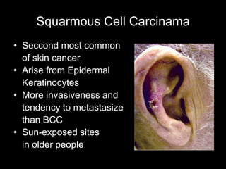 Squarmous Cell Carcinama
• Seccond most common
of skin cancer
• Arise from Epidermal
Keratinocytes
• More invasiveness and
tendency to metastasize
than BCC
• Sun-exposed sites
in older people
 