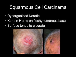 Squarmous Cell Carcinama
• Dysorganized Keratin
• Keratin Horns on fleshy tumorous base
• Surface tends to ulcerate
 