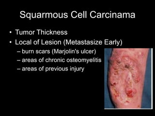 Squarmous Cell Carcinama
• Tumor Thickness
• Local of Lesion (Metastasize Early)
– burn scars (Marjolin's ulcer)
– areas of chronic osteomyelitis
– areas of previous injury
 