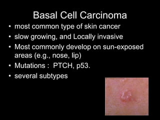 Basal Cell Carcinoma
• most common type of skin cancer
• slow growing, and Locally invasive
• Most commonly develop on sun-exposed
areas (e.g., nose, lip)
• Mutations : PTCH, p53.
• several subtypes
 