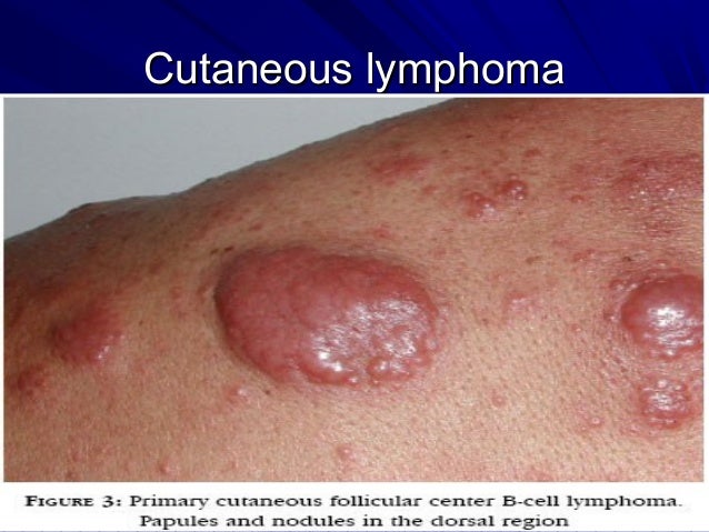 Skin Cancer