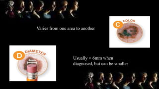 Varies from one area to another
Usually > 6mm when
diagnosed, but can be smaller
 