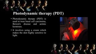 Photodynamic therapy (PDT)
• Photodynamic therapy (PDT) is
used to treat basal cell carcinoma,
Bowen's disease and actinic
keratoses.
• It involves using a cream which
makes the skin highly sensitive to
light.
 