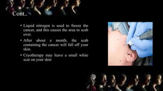 Cont..
• Liquid nitrogen is used to freeze the
cancer, and this causes the area to scab
over.
• After about a month, the scab
containing the cancer will fall off your
skin.
• Cryotherapy may leave a small white
scar on your skin
 