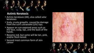 Actinic Keratosis
• Actinic keratoses (AK), also called solar
keratoses
• Scaly, crusty growths caused by damage
from the sun’s ultraviolet (UV) rays.
• Appear on sun-exposed areas such as
the face, scalp, lips, and the back of the
hands.
• Become red, but some will be tan, pink,
and/or flesh-toned.
• Second most common form of skin
cancer
 