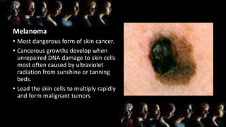 Melanoma
• Most dangerous form of skin cancer.
• Cancerous growths develop when
unrepaired DNA damage to skin cells
most often caused by ultraviolet
radiation from sunshine or tanning
beds.
• Lead the skin cells to multiply rapidly
and form malignant tumors
 