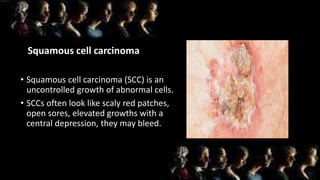 Squamous cell carcinoma
• Squamous cell carcinoma (SCC) is an
uncontrolled growth of abnormal cells.
• SCCs often look like scaly red patches,
open sores, elevated growths with a
central depression, they may bleed.
 