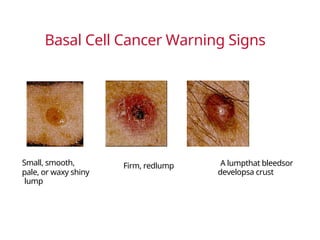 Skin_Cancer Risk summary, diagnosis and prevention | DOCX