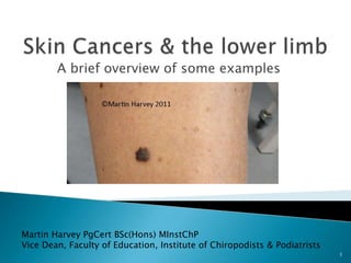 Skin Cancers & the lower limb A brief overview of some examples Martin Harvey PgCert BSc(Hons) MInstChP Vice Dean, Faculty of Education, Institute of Chiropodists & Podiatrists 1 