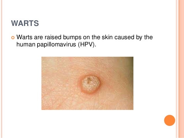 Skin cancer and warts