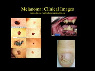 Early Detection of Melanoma and Other Skin Cancers | PPT