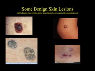 Early Detection of Melanoma and Other Skin Cancers | PPT