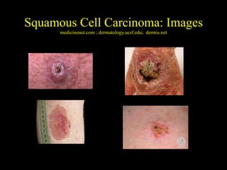 Early Detection of Melanoma and Other Skin Cancers | PPT