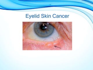 Eyelid Skin Cancer
 