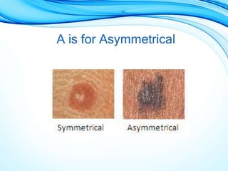 A is for Asymmetrical
 