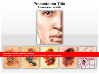 Presentation Title 
Presentation subtitle 
Skin Cancer Treatment Powerpoint Template 
http://www.scribd.com/doc/176166013/Skin-Cancer-Treatment-Powerpoint-Template 
 