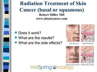 Radiation Treatment of Skin
    Cancer (basal or squamous)
               Robert Miller MD
              www.aboutcancer.com



   Does it work?
   What are the results?
   What are the side effects?
 
