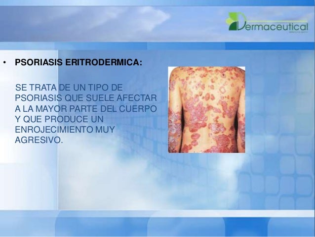 La alergia al frío y la psoriasis