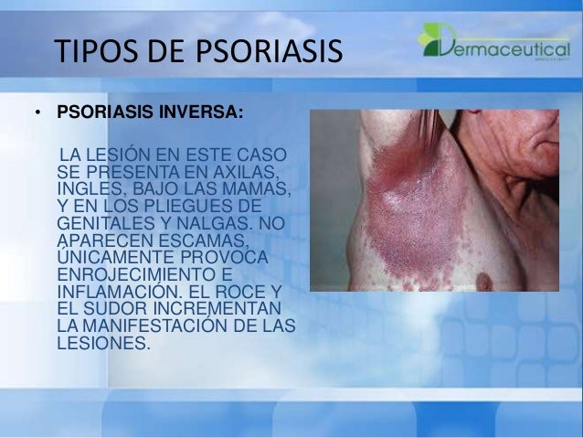 La psoriasis sobre los dedos de las manos el tratamiento por los medios públicos