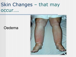Skin Changes   – that may occur…. Oedema 