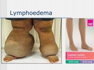 Lymphoedema 