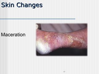 Skin Changes   Maceration 
