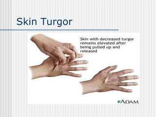 Skin Turgor 