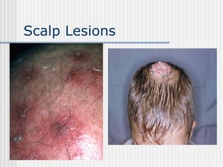 Scalp Lesions 