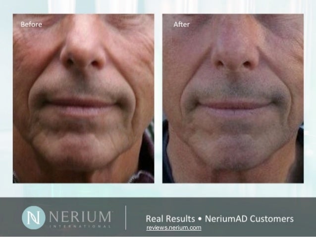 anti wrinkle treatment for men