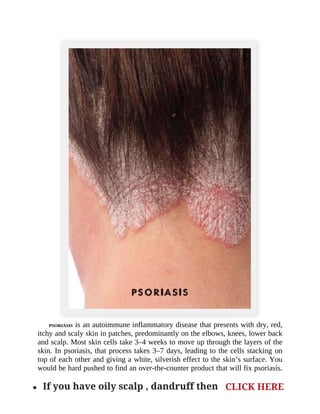 PSORIASIS	is	an	autoimmune	inflammatory	disease	that	presents	with	dry,	red,
itchy	and	scaly	skin	in	patches,	predominantly	on	the	elbows,	knees,	lower	back
and	scalp.	Most	skin	cells	take	3–4	weeks	to	move	up	through	the	layers	of	the
skin.	In	psoriasis,	that	process	takes	3–7	days,	leading	to	the	cells	stacking	on
top	of	each	other	and	giving	a	white,	silverish	effect	to	the	skin’s	surface.	You
would	be	hard	pushed	to	find	an	over-the-counter	product	that	will	fix	psoriasis.
. If you have oily scalp , dandruff then CLICK HERE
 