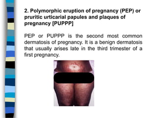 Pp Rash Skin changes and diseases in pregnancy | PPTX
