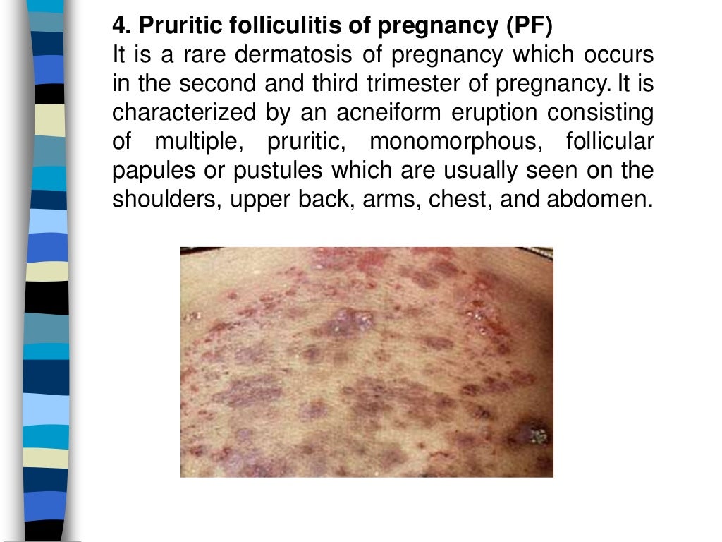 Skin changes and diseases in pregnancy