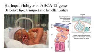 Harlequin Ichtyosis: ABCA 12 gene
Defective lipid transport into lamellar bodies
 