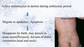 Active melanocytes in dermis during embryonic period
Migrate to epiderms / Apoptosis
Disappears by birth, may persist in
some areas(Presacral, dorsum of distal
extremities,head and neck)
Mongolian spots
 