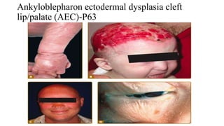 Ankyloblepharon ectodermal dysplasia cleft
lip/palate (AEC)-P63
 