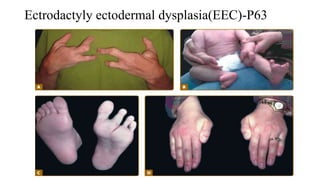 Ectrodactyly ectodermal dysplasia(EEC)-P63
 