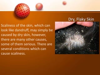 Dry, Flaky Skin
Scaliness of the skin, which can
look like dandruff, may simply be
caused by dry skin, however,
there are many other causes,
some of them serious. There are
several conditions which can
cause scaliness.
 