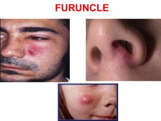 Furunculus Rashes Skin disease ppt for nursing student | PPTX