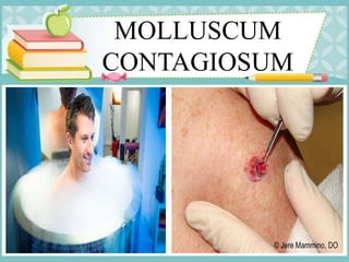 MOLLUSCUM
CONTAGIOSUM
 
