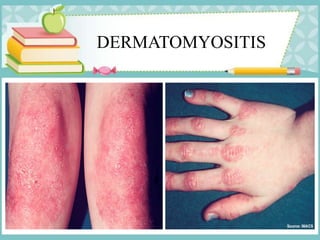 DERMATOMYOSITIS
 